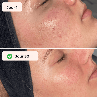 Gant Exfoliant Poils Incarnés