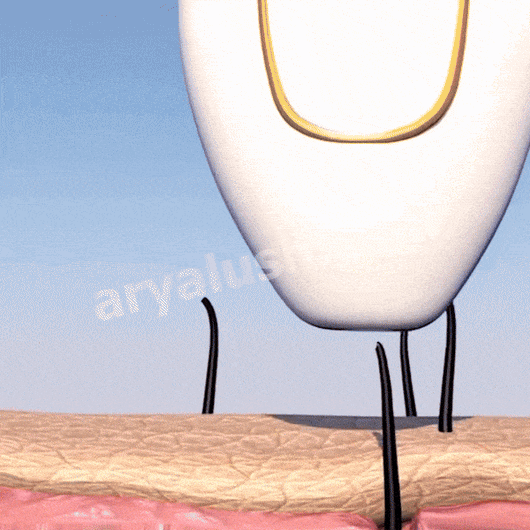 IPL Pulse • Épilateur à Lumière Pulsée