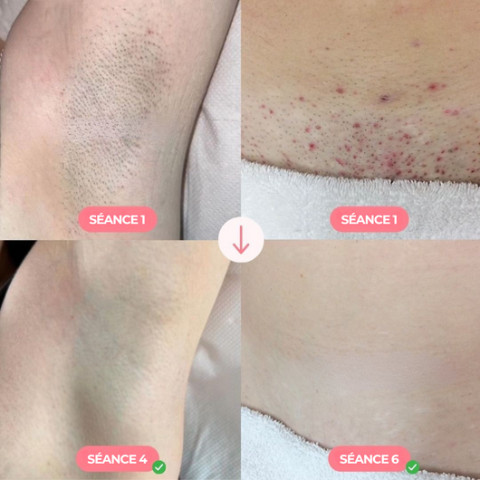 IPL Pro • Épilateur à Lumière Pulsée